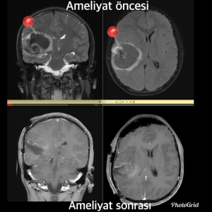 Hastanemizdeki beyin tümörü ameliyatı olan hastamız