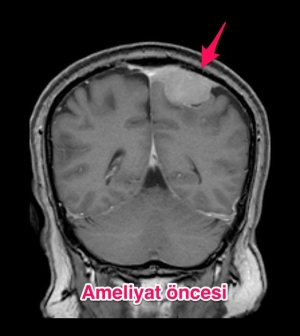 Dün ameliyat ettiğimiz beyin tümörü hastamın ameliyat öncesi ve ameliyat sonrası çekilmiş beyin MR ...