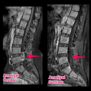 Omurilik tümörü öncesi ve sonrası